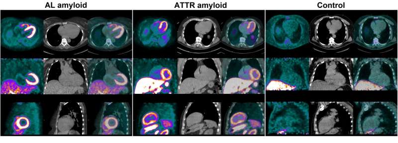 PET imaging visualizes hard-to-diagnose cardiac amyloidosis