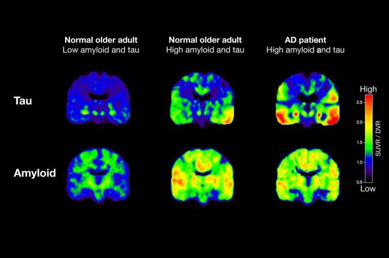 PET scans reveal key details of Alzheimer's protein growth in aging brains