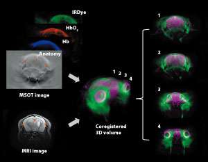 Photoacoustic and magnetic resonance imaging visualizes blood flow and oxygenation status in brain tumor tissue