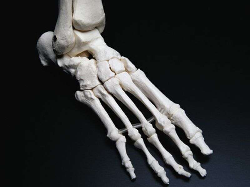 Post-op gouty arthritis described in patient taking thiazide