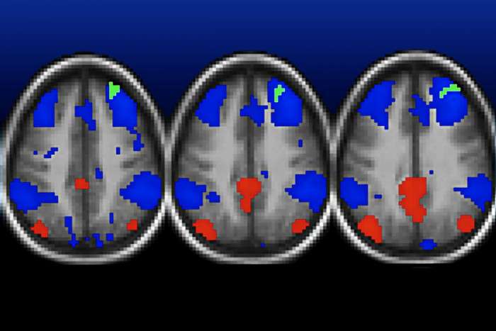 Poverty linked to childhood depression, changes in brain connectivity