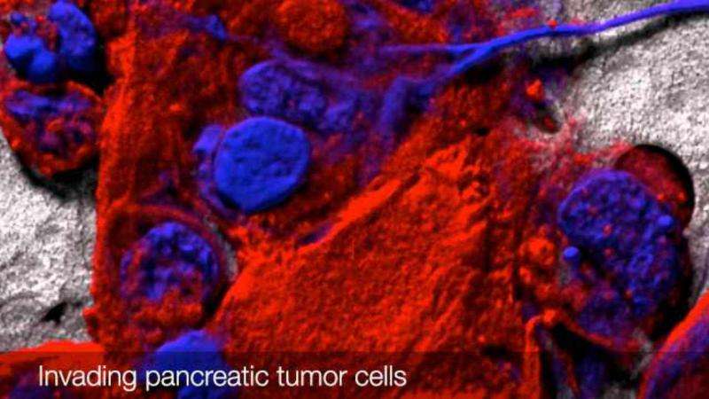 辐射治疗胰腺癌手术候选人的重要补充