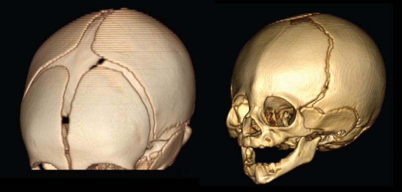 Rare and common genetic variants combine to cause skull-fusion disorder
