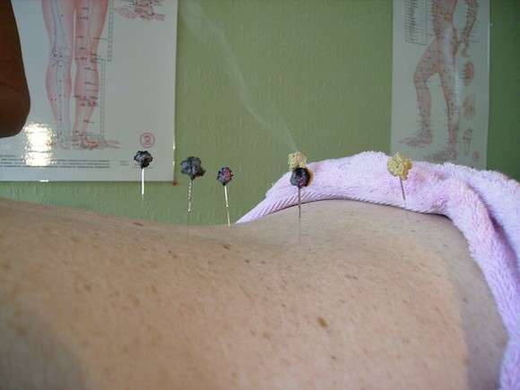 Real acupuncture no better than sham acupuncture for treating hot flushes