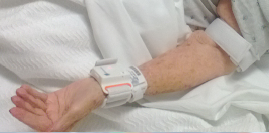 Simple arm test accurately identifies markers of frailty in older adults facing surgery