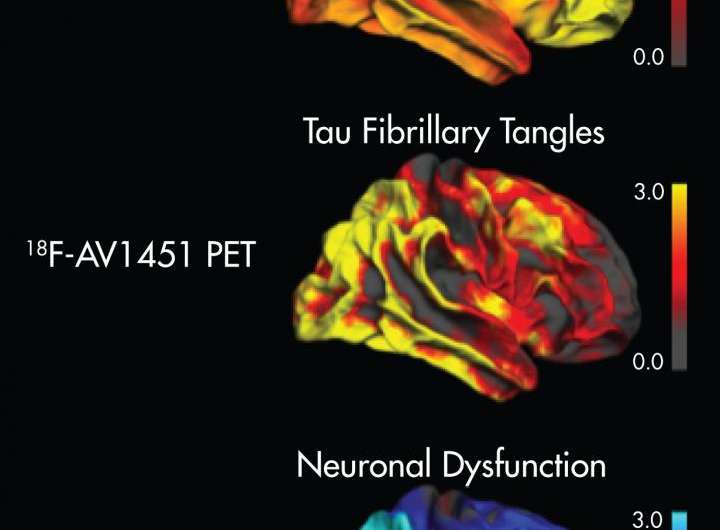 今年SNMMI形象:小说PET成像显示τ累积与神经退化