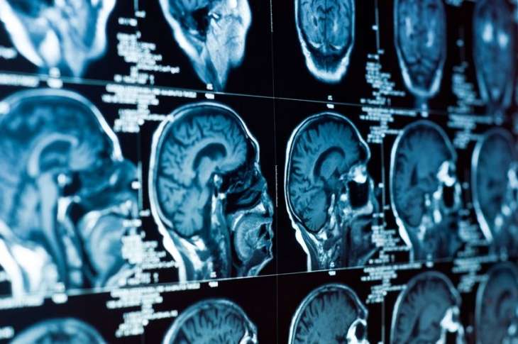 Specific brain areas found to be linked to depression