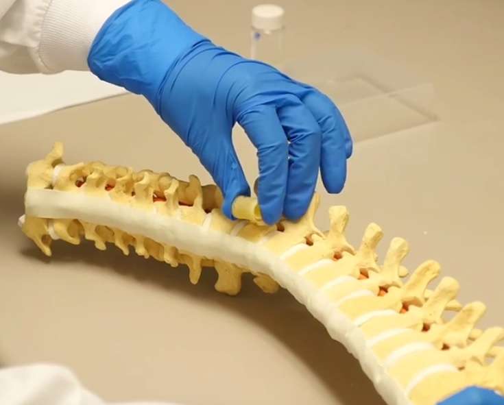 Spongy material helps repair the spine (video)