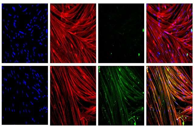 Stem cell gene therapy could be key to treating Duchenne muscular dystrophy