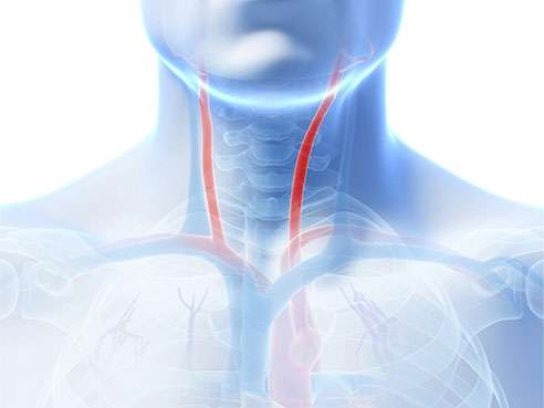 Stroke risk increases from stenting in older patients