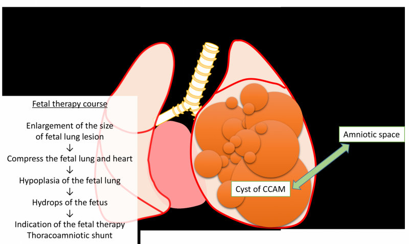 Successful treatment for a severe case of fetal lung disorder CPAM