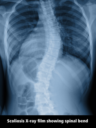 Superelastic adaptive alloy could improve the success rate of childhood scoliosis treatment