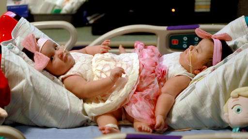 手术开始在德克萨斯州分离婴儿连体双胞胎
