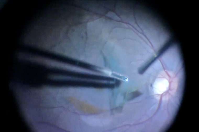Surgery can restore vision in patients with brain injuries