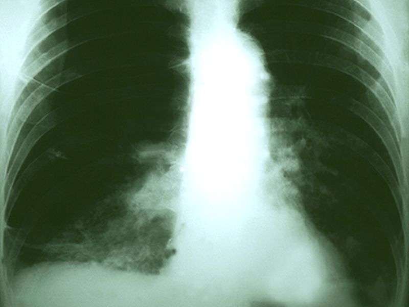 手术与肺癌患者的更长生存