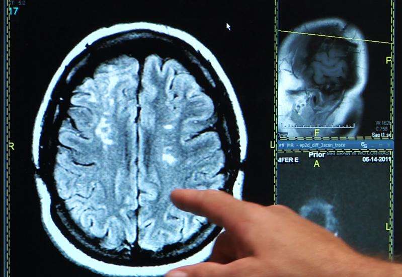 Survey finds 73 percent unaware of stroke symptoms