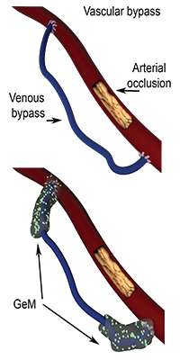 The vascular bypass revolution