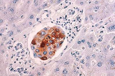 Triple-negative breast cancer target is found