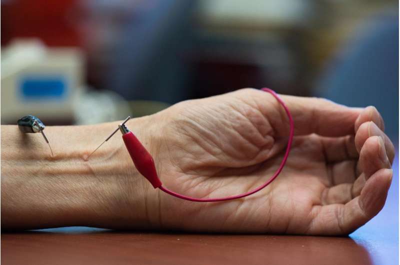 UCI study finds acupuncture lowers hypertension by activating natural opioids