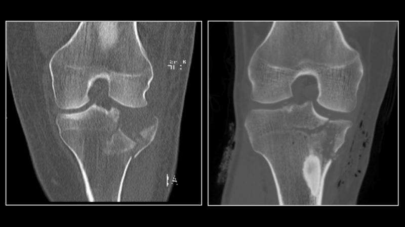 Ultra-low dose CT scans successfully detect fractures