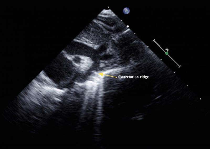 Ultrasound detects heart dysfunction after successful repair of aortic narrowing
