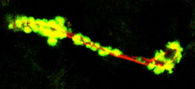 Unique structure of brain blood vessel amyloid latest clue to Alzheimer's development?