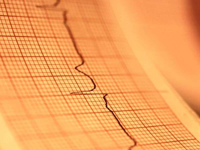 Ventricular ectopic QRS interval may be useful post-MI marker