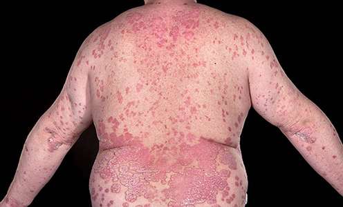 Weight loss reduces psoriasis symptoms