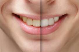 What causes discolored teeth and is there any way to cure or prevent staining?