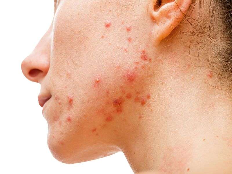 Why acne can strike women after the teen years