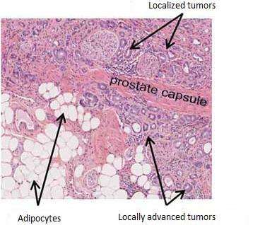 Why prostate cancer is more aggressive in obese patients