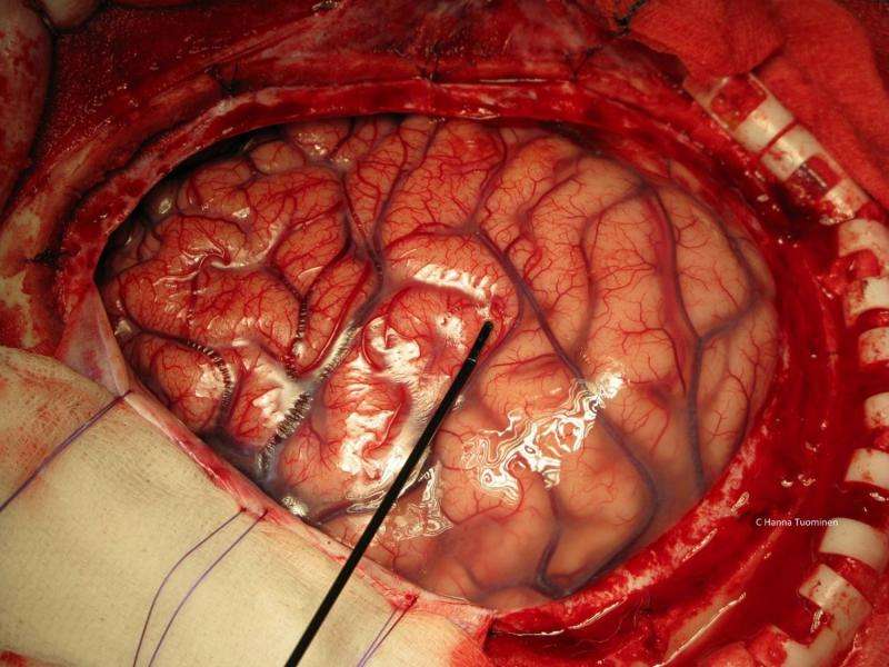 “Wrong” scale used to evaluate results of brain surgery