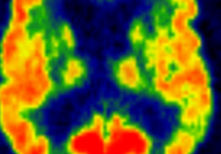 Alzheimer’s disease study links brain health and physical activity