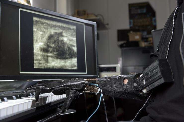 Amputee controls individual prosthetic fingers via ultrasound technology