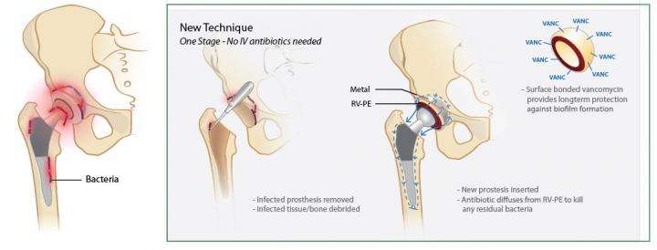 Antibiotic-releasing polymer may help eradicate joint implant infection