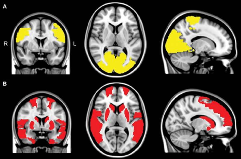 Brain disconnections may contribute to Parkinson's hallucinations