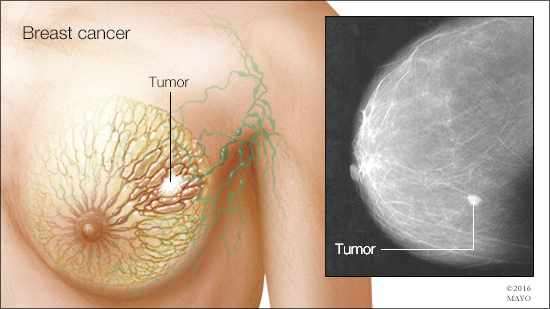 Breast cancer study provides critical information on tumor sequencing and chemother