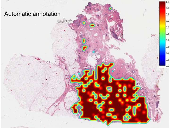Computer accurately identifies and delineates breast cancers on digital tissue slides