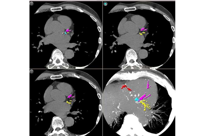 CT shows enlarged aortas in former pro football players