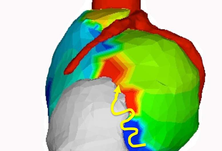 Deadly heart rhythm halted by noninvasive radiation therapy