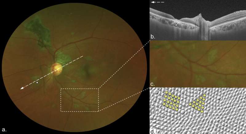 Ebola survivors have a 'unique' retinal scar