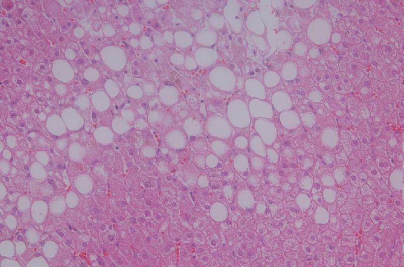 Fatty liver diagnosis improved with magnetic resonance