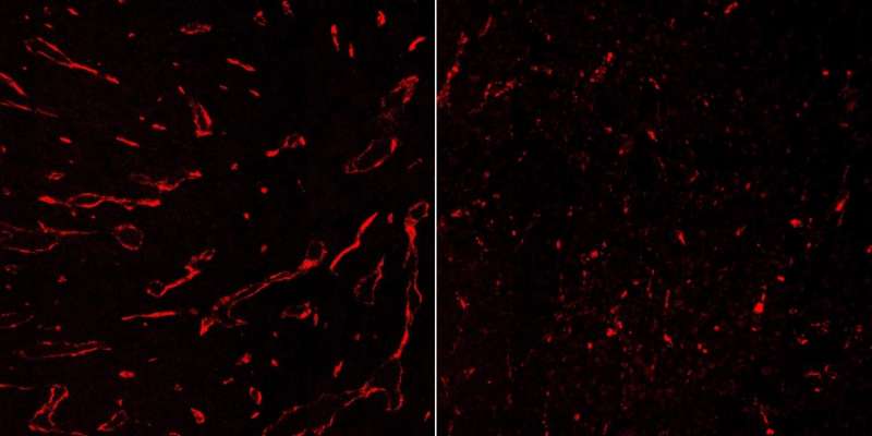 Fighting cancer with immunotherapy: Signaling molecule causes regression of blood vessels