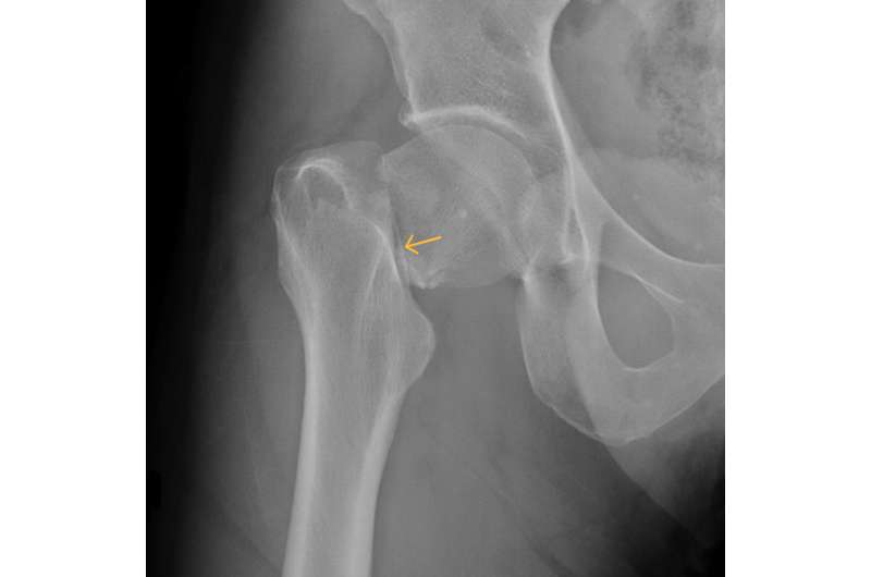 Five questions to ask a doctor about your hip fracture