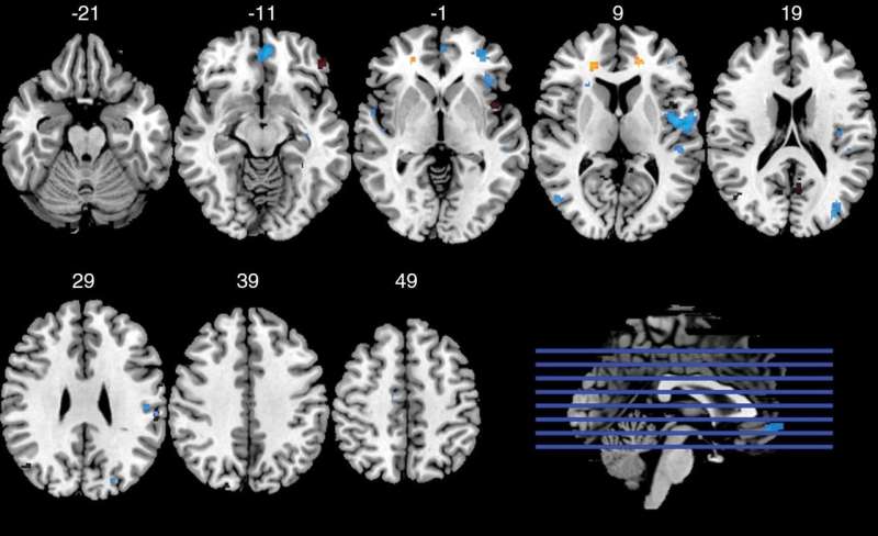 Football position and length of play affect brain impact