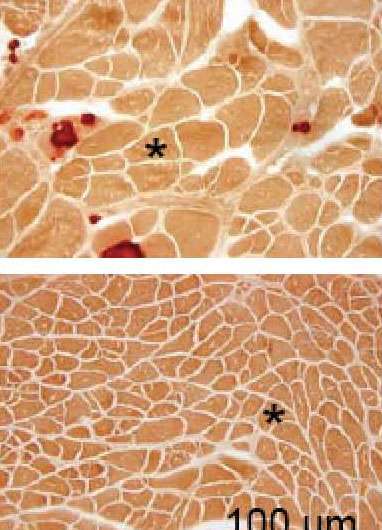 Gene transfer corrects severe muscle defects in mice with Duchenne muscular dystrophy