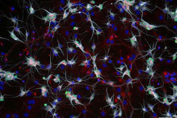 Harvard scientists find evidence that ALS and SMA could be treated with a common drug