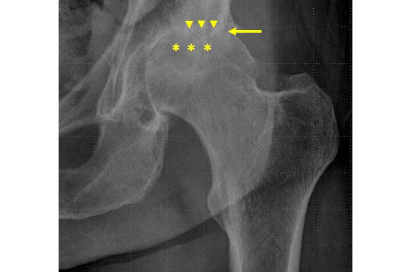 Hip steroid injections associated with bone changes