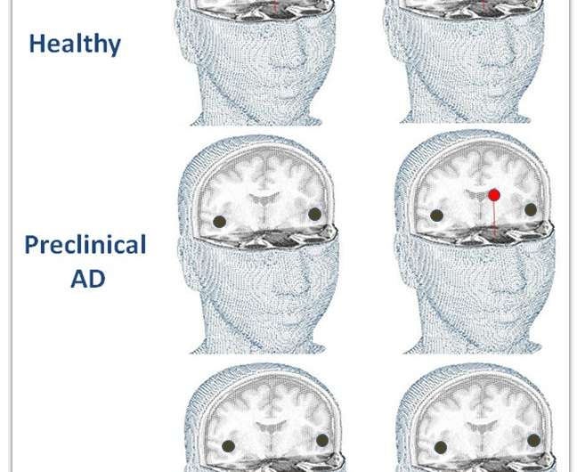 'Ideal biomarker' detects Alzheimer's disease before the onset of symptoms