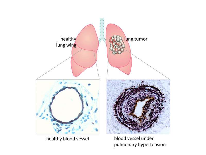 Lung cancer triggers pulmonary hypertension